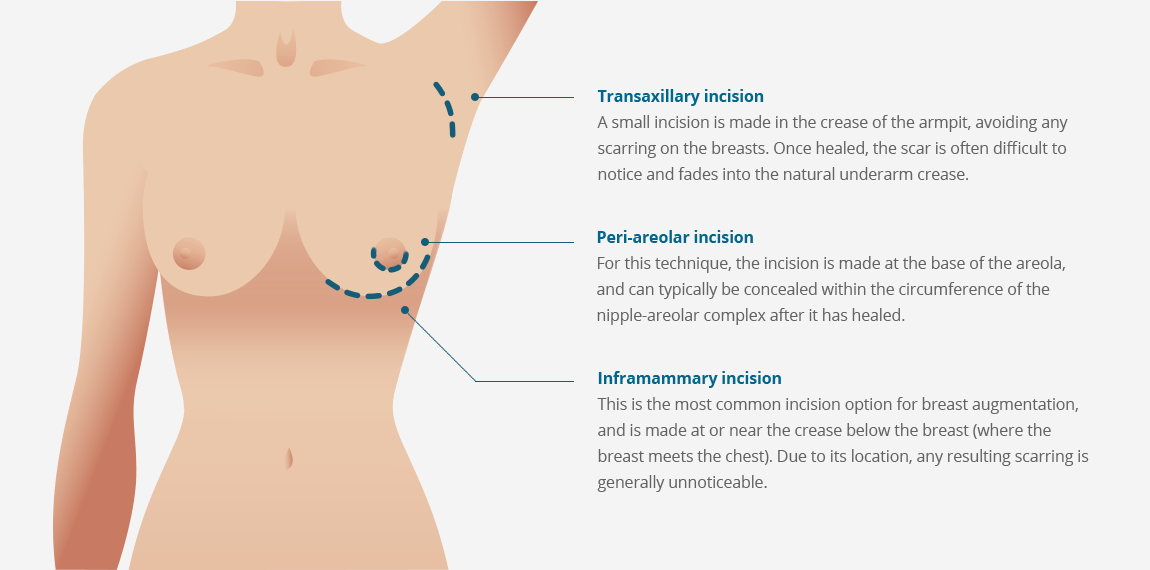 Breast Augmentation Incision Techniques: Areolar vs. Inframammary!